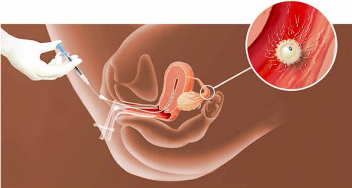 Centre-de-Fertilité-PMA_Traitement-et-PMA_2.-Insémination-Artificielle-IAC---700x374