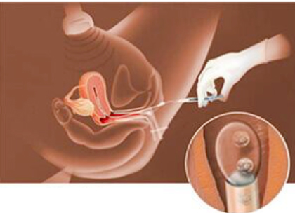 Centre-de-Fertilité-PMA_Traitement-et-PMA_Transfert-d’embryons---420x304
